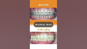 Hành trình LỘT XÁC nhờ niềng răng của Thu Hiền