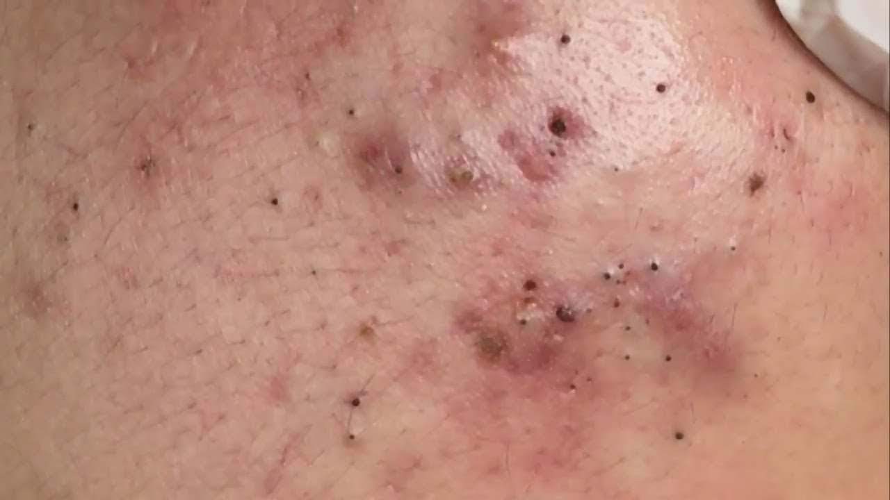 Best Pimples Popping Blackheads 30/04/2021 2 YouTube