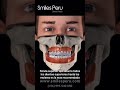 Férula dental nocturna/ Night dental guard
