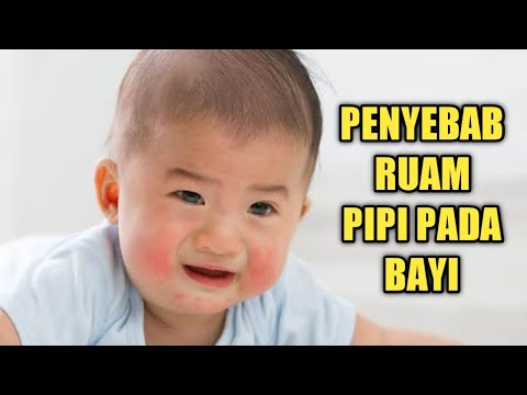 Video: Mengapa Anak Itu Memiliki Pipi Merah?