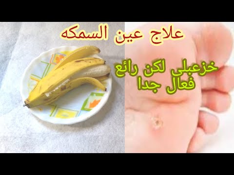علاج عين السمكة فى القدم طريقة فع الة بدون جراحة وصفه بسيطة لعلاج مسمار القدم