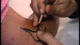 How to perform corticosteroid injections of the elbow by Dr. A.N. de Wolf