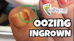 Oozing Ingrown Toenail From The Salon. | Healthy Feet Podiatry Tampa and Wesley Chapel Florida 