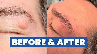 EYELID CYST! | BEFORE & AFTER