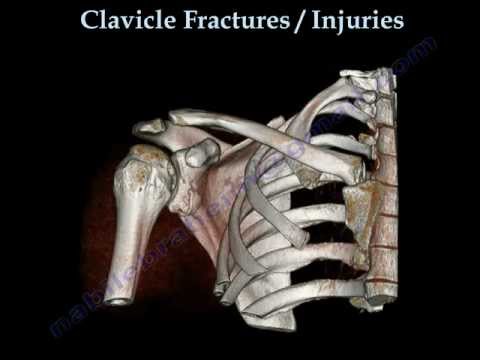 CLAVICLE FRACTURE  treatment and repair - Everything You Need To Know - Dr. Nabil Ebraheim