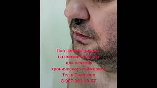 Лечение пиявками гайморита.