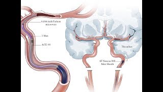 4.5 Minute Thrombectomy Using the ADAPT-FAST Technique and the ACE68 Catheter