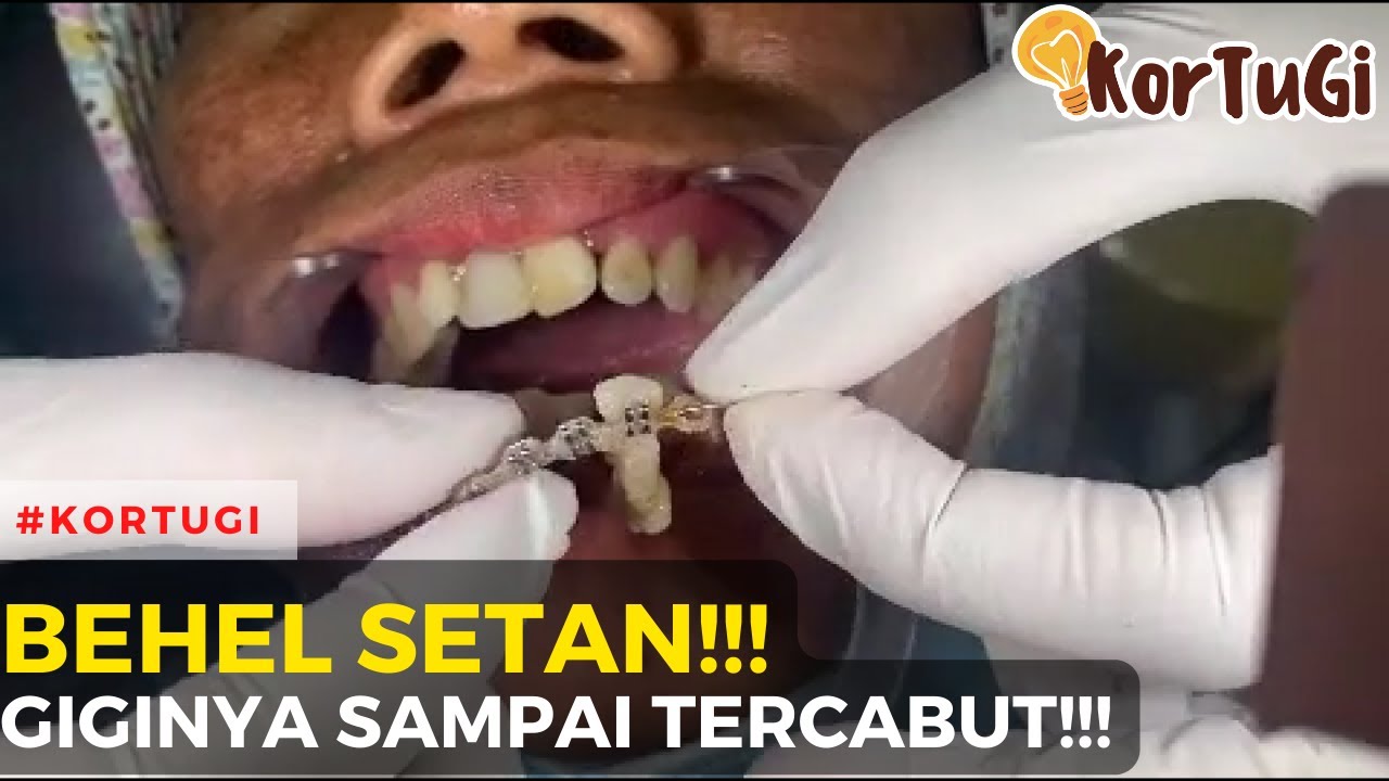 NOMBOK!!! Pasang Behel, Gigi TERCABUT!!! | KorTuGi