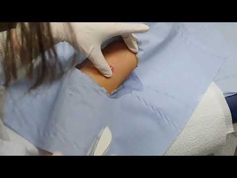 კანქვეშა კონტრაცეპტივის ჩადგმა