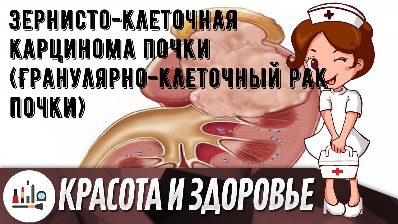 Зернисто-клеточная карцинома почки (Гранулярно-клеточный рак почки ...