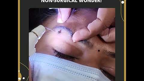 Plexr Plasma Pro- non surgical wonder!