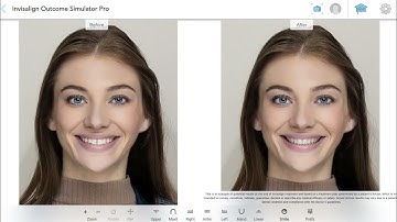 Realistic smile visuals with Invisalign® Outcome Simulator Pro