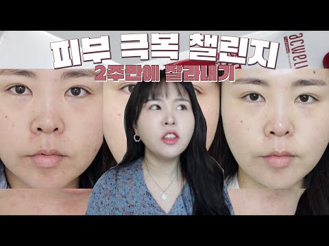 NO피부과 요즘 내 피부가 좋아진 이유🧖🏻‍♀3주 극락 챌린지 찐후기+너도 극락 가자_아큐리얼-<strong>나인</strong> 컨트롤 엑스 듀오