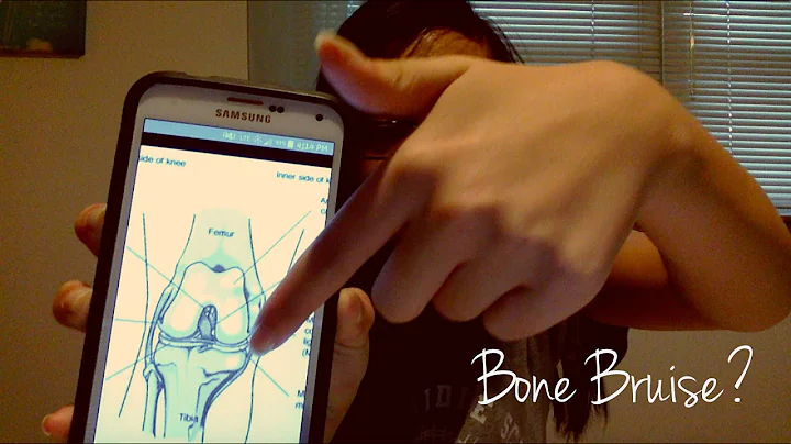 BONE BRUISE? | Betty Wolfgram