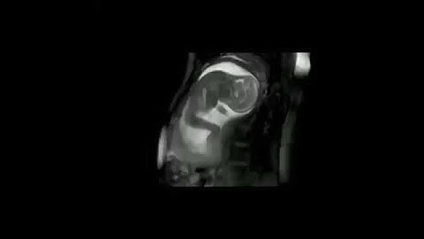 Movimientos fetales en el embarazo visto por Resonancia Magnética