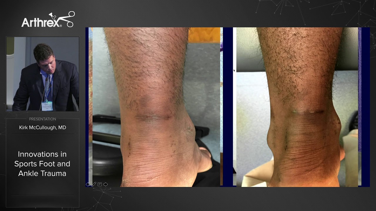 Innovations in Sports Foot and Ankle Trauma orthopedic banawe