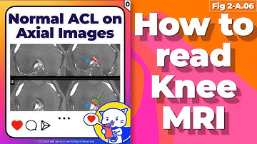 (Fig 2-A.06) Normal ACL on axial images