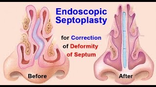 Endoscopic Septoplasty for Correction of Deformity of Septum | ENT Surgery