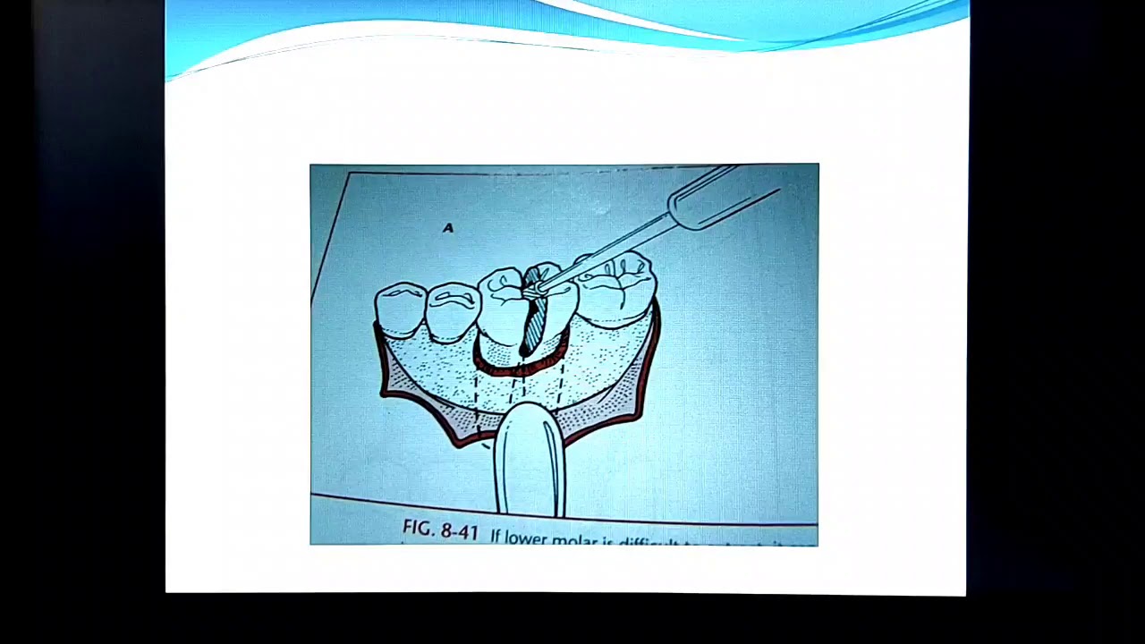 Surgical extraction   ( trans alveolar extraction) video two