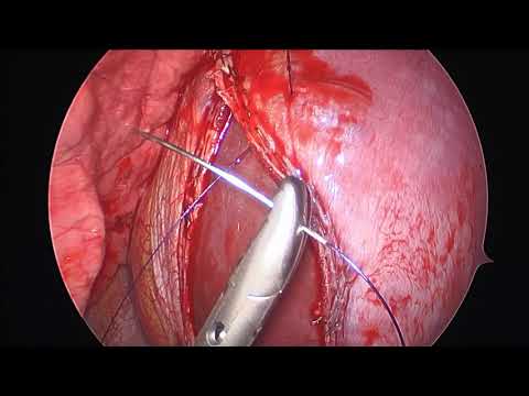 cVATS (2 port) for catamenial pneumothorax (月経随伴性気胸に対する胸腔鏡下手術)