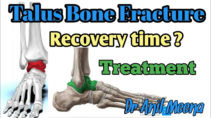 talus bone fracture recovery time | talus bone fra...