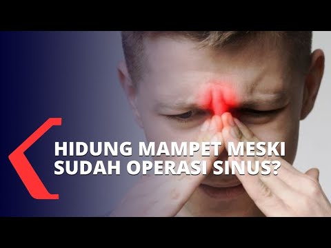Video: Reseksi Versus Pelestarian Turbin Tengah Dalam Operasi Untuk Rinosinusitis Kronis Dengan Poliposis Hidung: Uji Coba Terkontrol Secara Acak