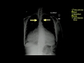 Teach Me Chest - Case 20 (Do the interactive case first. Details in description.)