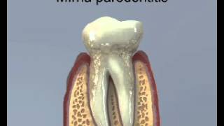 Parodontitida Paradentóza Gum Disease Periodontal Disease Pyorrhoea