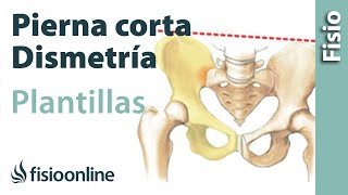 Plantillas para dismetría o pierna corta  ¿Acierto o error?