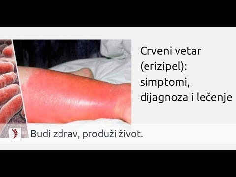 Crveni vetar (erizipel): simptomi, dijagnoza i lečenje