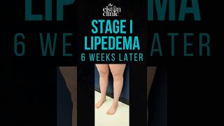 LIPOSUCTION FOR LIPEDEMA  STAGE 1 LEGS AND KNEES #lipedema