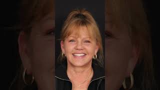 Early 60s Deep Plane Facelift Patient Content