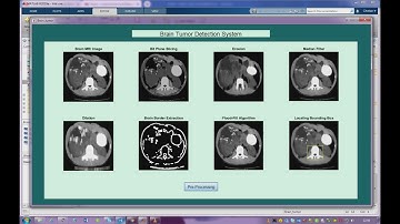 brain tumor detection system using Matlab | image processing | machine learning | brain| tumor