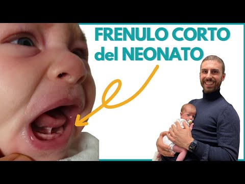 Video: Quando viene diagnosticata l'anchiloglossia?