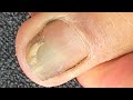 THICK TOENAIL WITH FUNGUS AMAZING PEDICURE TRANSFORMATION