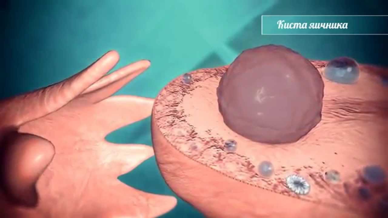 Хирургическое лечение кисты яичника