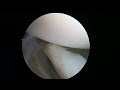 R shoulder arthroscopic debridement 1 16 23 JT