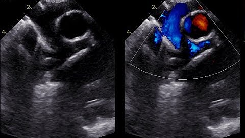 Echocardiography of Glenn procedure