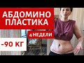 ТАКОГО Я НЕ ОЖИДАЛА! |  4 НЕДЕЛИ | ДО И ПОСЛЕ | АБДОМИНОПЛАСТИКА |  ПОДТЯЖКА ЖИВОТА И РУК