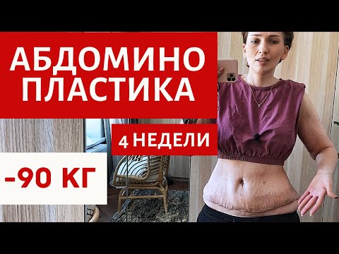 Видео: Абдоминопластика на корема - рецензии, преди и след