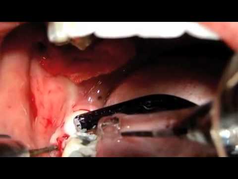 Extraccin de tercer molar mesioangular