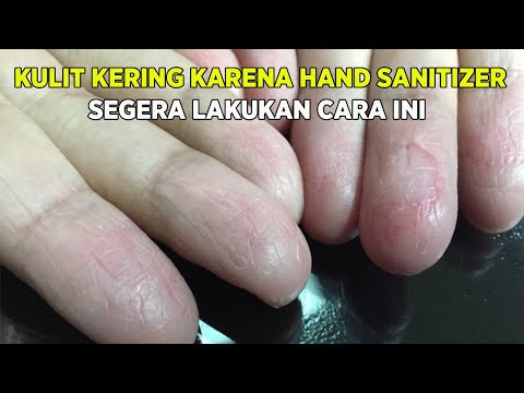 Kulit Tangan Kering Karena Hand Sanitizer, Kembalikan Dengan Cara Ini