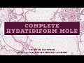 Complete hydatidiform mole