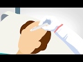 How does hair implantation works  modified hair implant  mhi  vplant advannced hair clinic