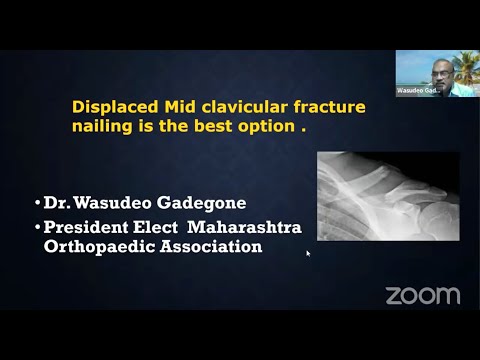 Dr Wasudeo Gadegone - Displaced Mid Clavicular Fracture Nailing is the Best Option