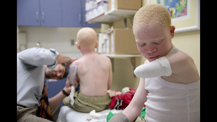 Global Journalist: Africans with albinism face dis...