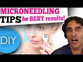 MICRONEEDLING DIY at HOME // What You Need to Know