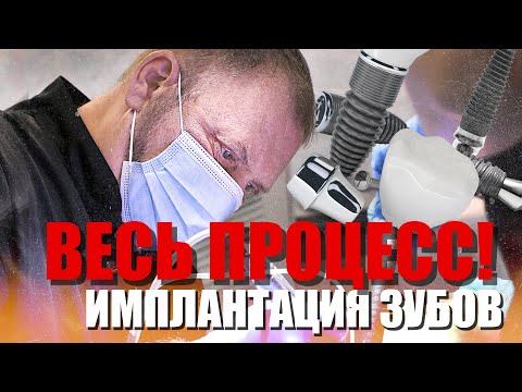 Имплантация зубов, весь процесс