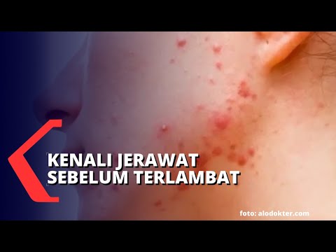 Cara Mencegah dan Mengatasi Jerawat pada Kulit