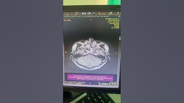 MRI of the brain with intravenous contrast enhancement